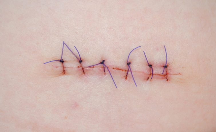 types-de-suture-en-chirurgie